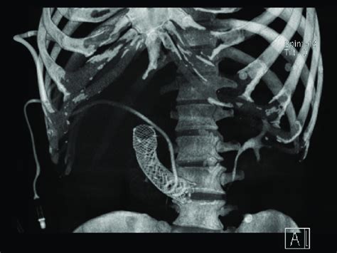 Computed Tomography 3 D Reconstruction Demonstrating Successful Download Scientific Diagram