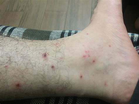 Are those bed bugs bites ?? : r/Bedbugs