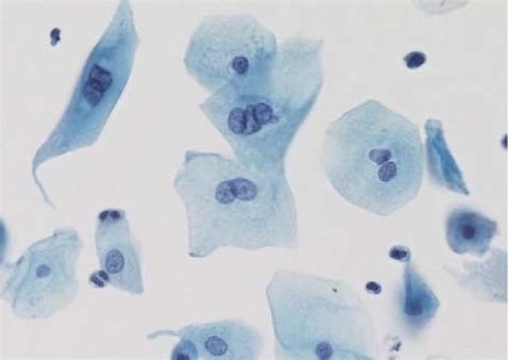 The Anal Pap Smear Cytomorphology Of Squamous Intraepithelial Lesions