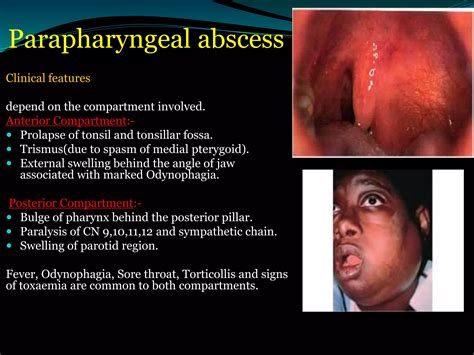 Surgical Treatment Of Paraphyrngeal And Retropharyngeal Abscesses Ppt