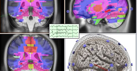 Study looks inside the brain during sleep to show how memory is stored ...