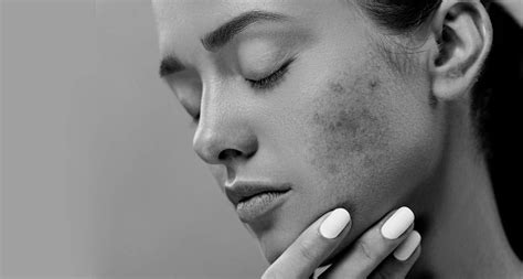 Acne Scarring - Dermis Advanced Skin Care Ottawa