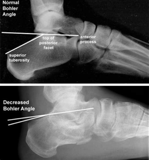 Calcaneus Fractures – Core EM