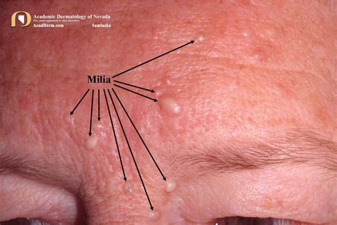 Milia: Milium, Milia En Plaque... - Academic Dermatology of Nevada