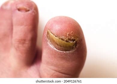 Onychomycosis Fungal Infection Nail Mycosis Foot Foto Stock