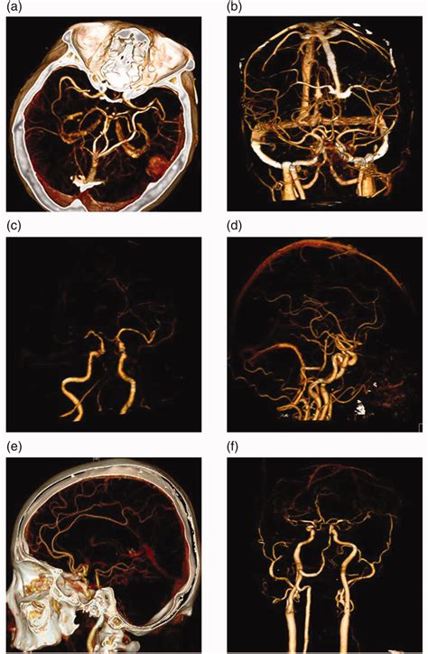 Computed Tomography Angiography Scan Of Ischemic Cerebrovascular Download Scientific Diagram