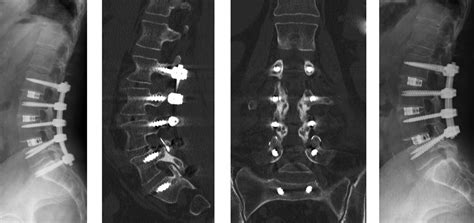 Pedicle Fracture