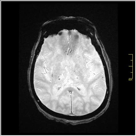 Binswanger Disease Image