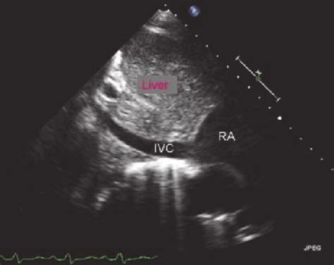 Ultrasound determination of inferior vena cava (IVC) diameter; RA=right ...