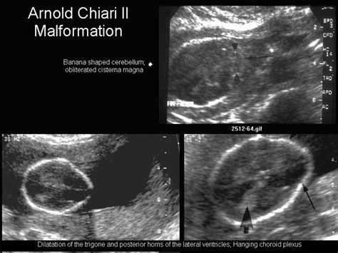 Arnold Chiari Malformation Ultrasound