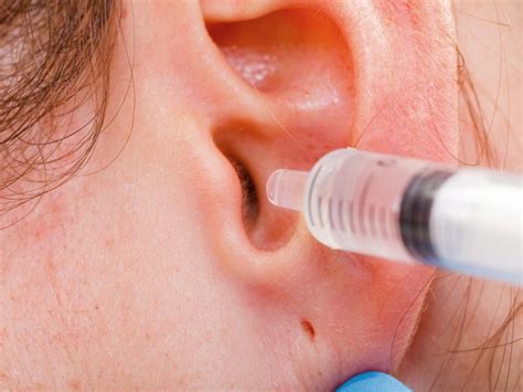 Cerumen (Ear Wax) Impaction Removal at MD First Primary & Urgent Care