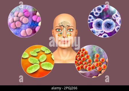 Anatomie De La Rhinosinusite Et Des Bact Ries Qui Causent La Sinusite