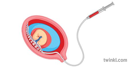 Chorionic Villi Sampling Diagram جنسی جینیاتی جین صنف سائنس سیکنڈری