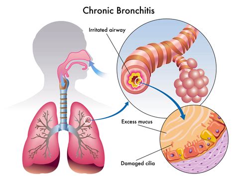 Bronchitis - 3 Natural Remedies To Try - Professional Supplement Center