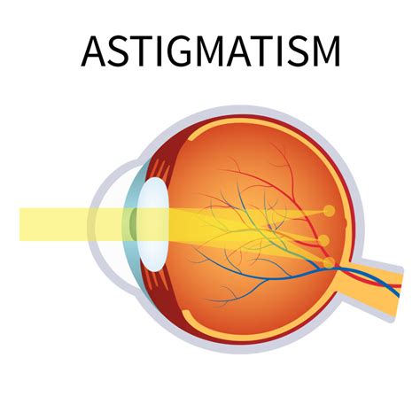 Cataract Surgery and Astigmatism | North Toronto Eye Care