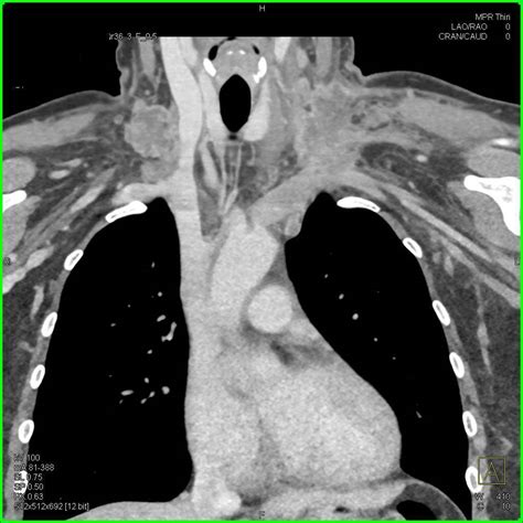 Lymphoma With Impressive Left Supraclavicular Nodes Neuro Case