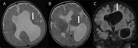 Mri Shows Unilateral Hydrocephalus Download Scientific Diagram