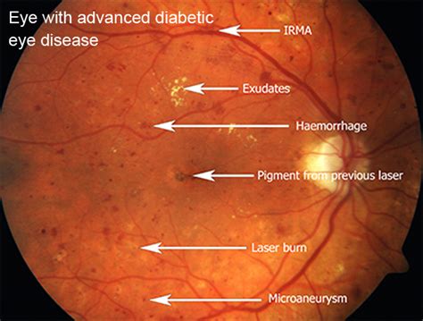 Fundus Photography Coatsworth Eye Clinic