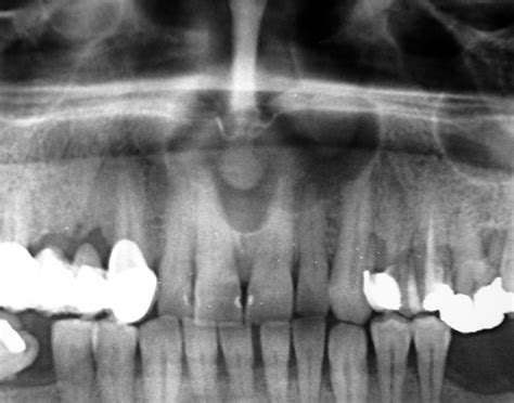 Keratocystic Odontogenic Tumors Clinical And Molecular Features