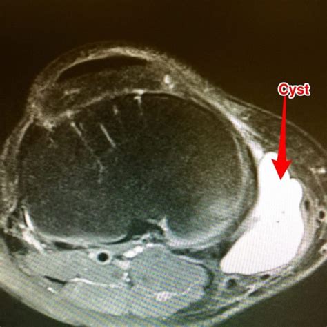 Parameniscal Cysts And Meniscus Tears Howard J Luks Md