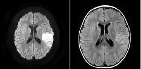 Middle Cerebral Artery Territory Infarct - DocNeuro