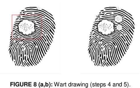 PDF Generation Of Skin Diseases Into Synthetic Fingerprints