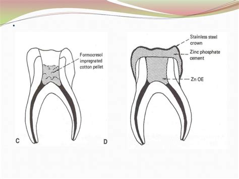 Pulpotomy