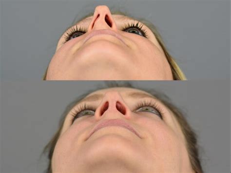 Nose Surgery Before After Patient 11 Dr Marotta