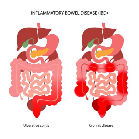 Unspezifische entzündliche Darmerkrankungen IBD Welche Arten und