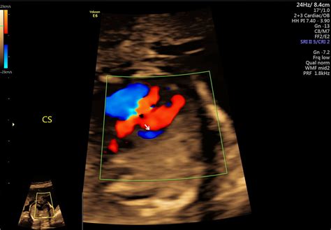 Color Doppler Sachdeva Diagnostics