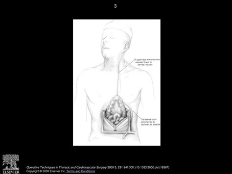 Esophageal Anastomosis Ppt Download