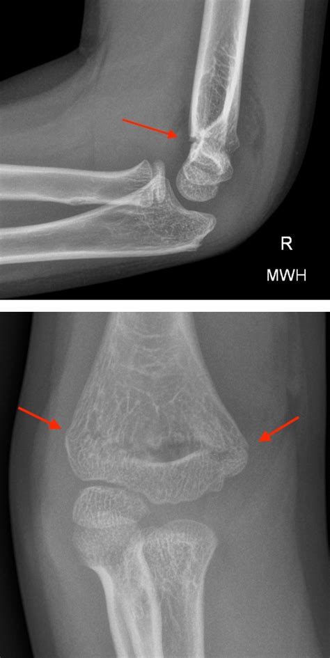 Pediatric Elbow Radiology U Of U School Of Medicine