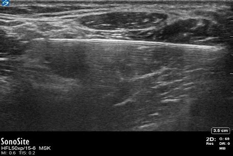 Ultrasound Image Optimization And Two Dimensional Artifacts