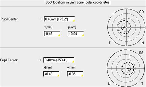 Avoiding Misinterpretations Of Kappa Angle For Clinical Research