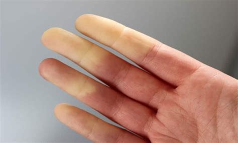 Raynaud Hastalığı Nedir Prof Dr Yavuz Beşoğul