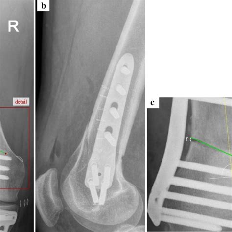 Mediolateral Dislocation After Medial Cortical Hinge Fracture A