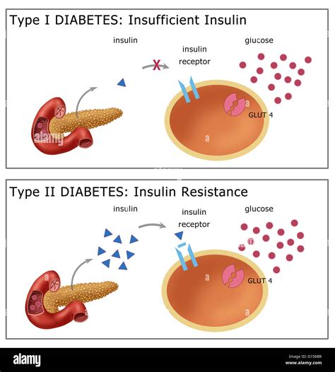 Illustration Comparing Type I Diabetes Top Where The Body Fails To