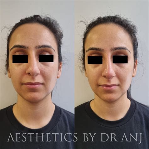 Non Surgical Rhinoplasty — Aesthetics By Dr Anj