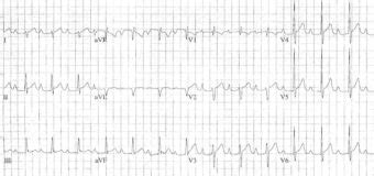 Biatrial Enlargement • LITFL • ECG Library Basics