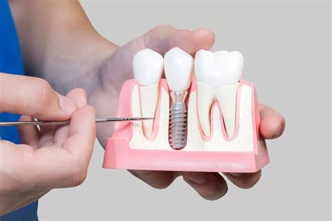 Full Arch Teeth Replacement With Dental Implants Ace Dental Clinic