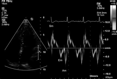 What Is Lv Diastolic Dysfunction | Natural Resource Department