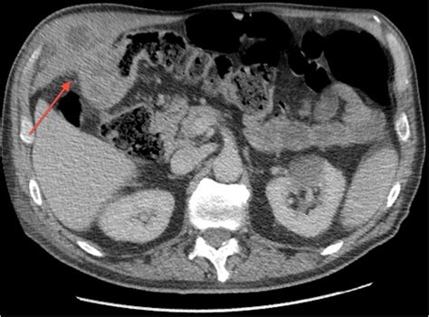 Colonic Tumour Presenting As Discrete Upper Abdominal Mass BMJ Case