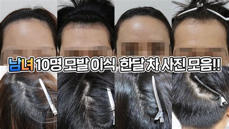 모발 이식 후 머리카락이 빠지는 시기 모발 이식 한달 차 실제 사례들 Feat암흑기를 이겨내는법 모발이식 탈모