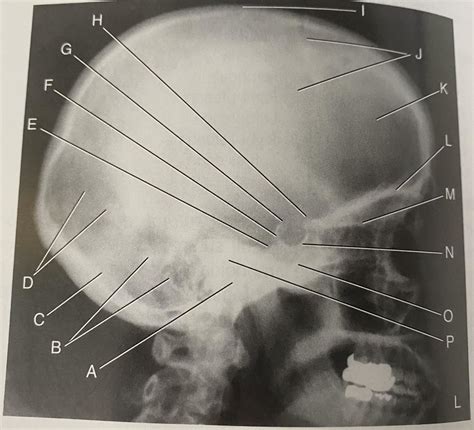 Lateral Skull Radiograph Diagram Quizlet