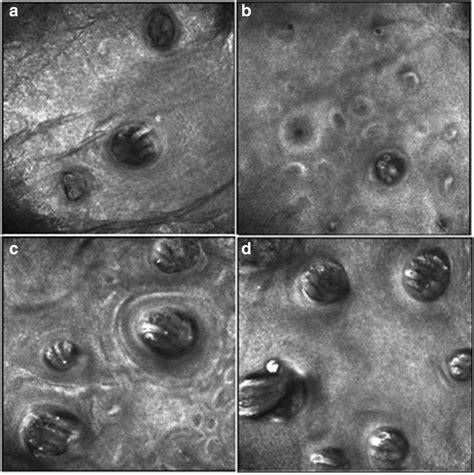 Imaging Of Demodex Mites On 1 Mm × 1 Mm Sectioning Via Rcm When The Download Scientific