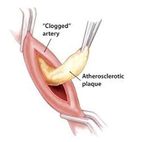 Springfield Heart Surgeons LLC - Femoral Endarterectomy