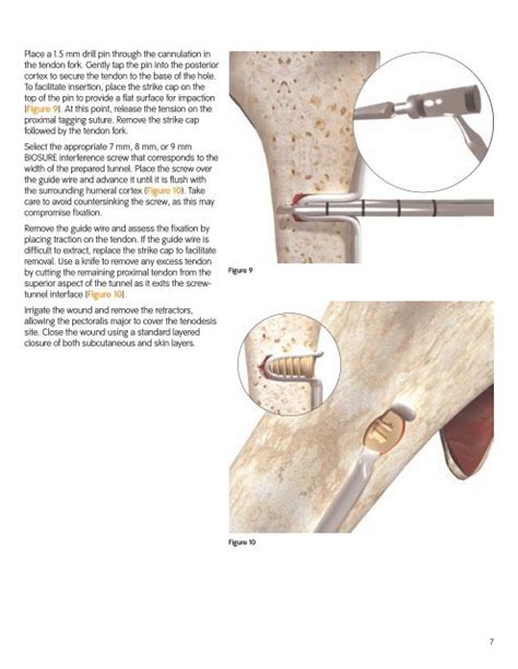 Surgical Technique Sub Pectoral Biceps Smith Nephew