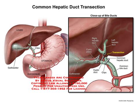 Common Hepatic Duct