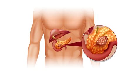 Os Sintomas E Tratamentos Do Câncer De Pâncreas