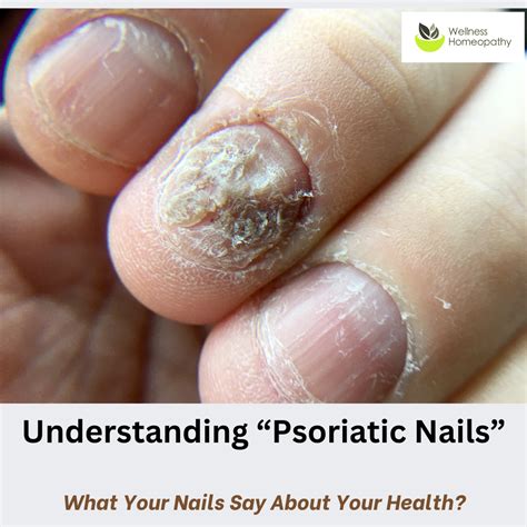 Understanding Psoriatic Nails A Holistic Approach For Relief Wellness Homeopathy Nz